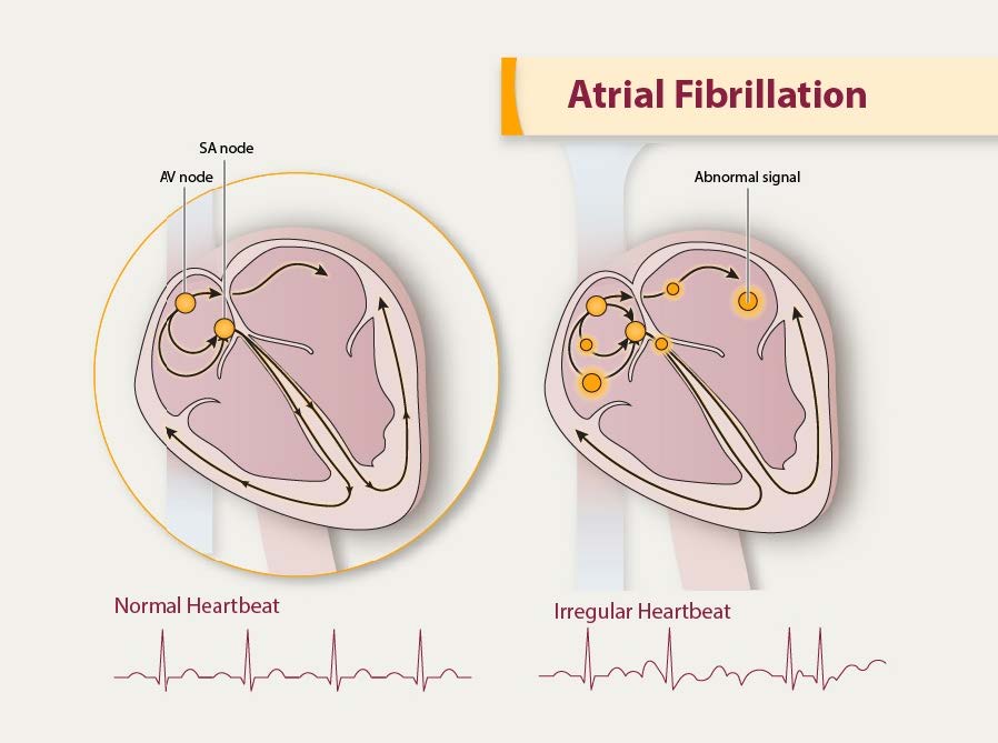 Atrial Fibrillation Adoration Home Health And Hospice